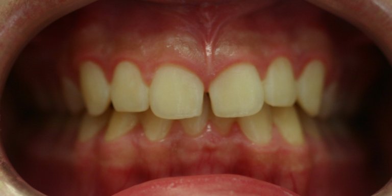 Braces — Bite Correction — before treatment