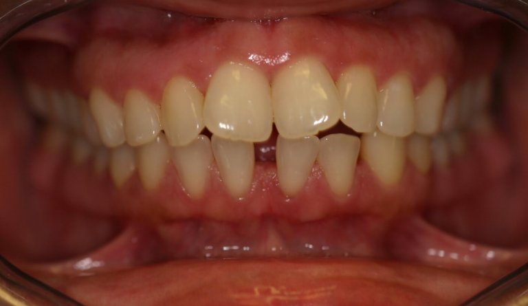 Braces — Alignment & Spacing — before treatment
