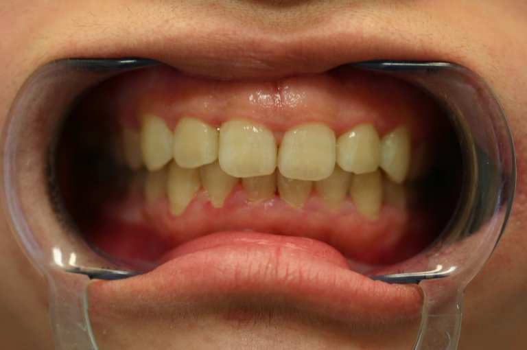Braces — Crowding Correction — after treatment