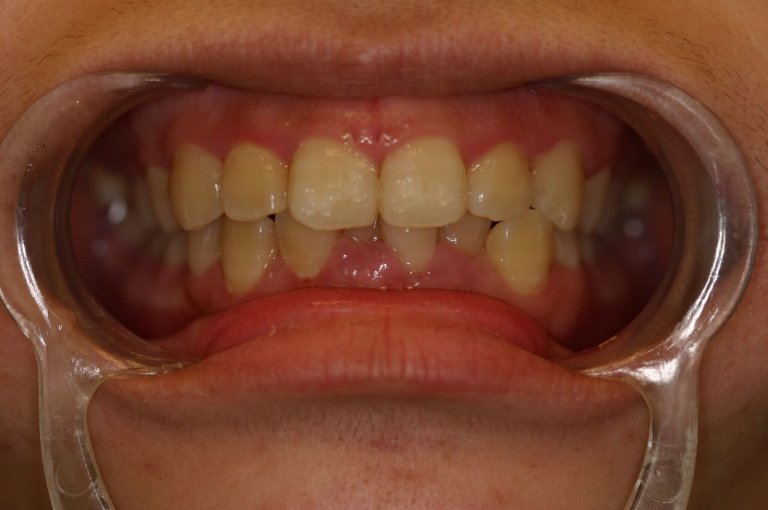 Braces — Crowding Correction — before treatment