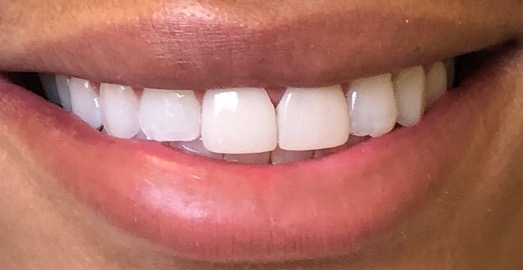 Dental Crowns — Front Tooth Restoration — after treatment