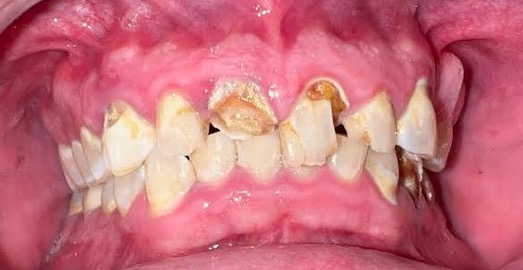 Dental Crowns — Smile Restoration — before treatment