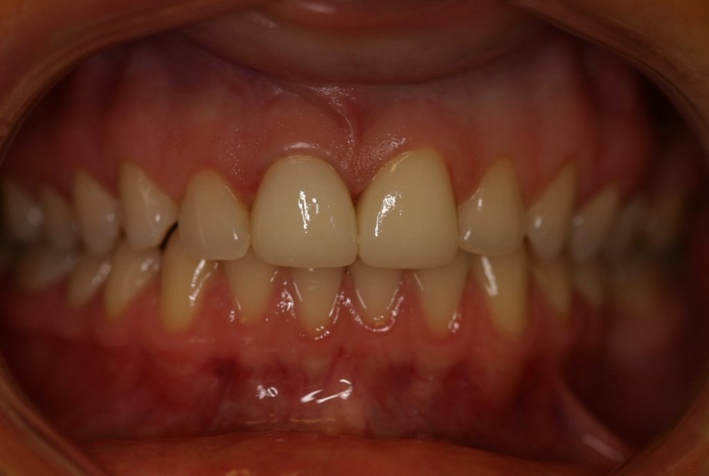 Dental Crowns — Full Smile Makeover — after treatment