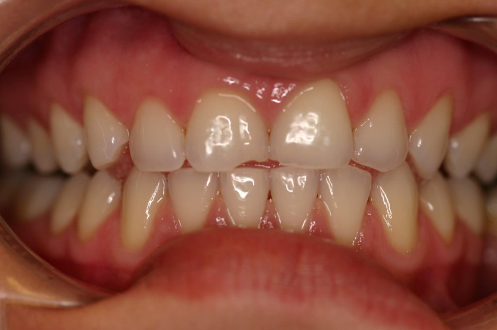 Dental Crowns — Full Smile Makeover — before treatment