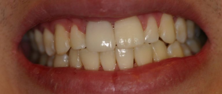 Dental Implants — Missing Tooth Replacement — after treatment