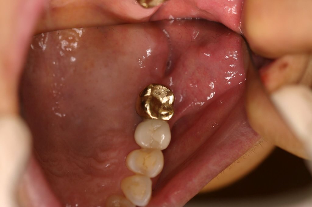 Dental Implants — Natural-Looking Restoration — before treatment