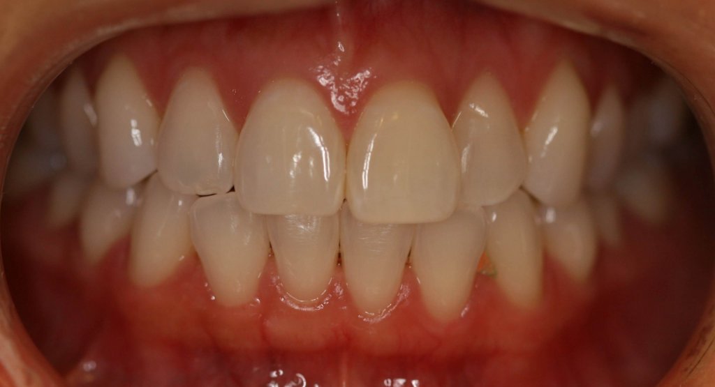 Invisalign — Discreet Alignment — before treatment