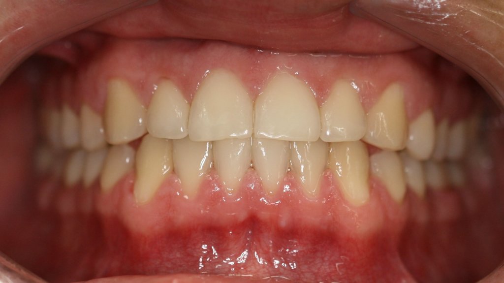 Invisalign — Straightened Smile — after treatment