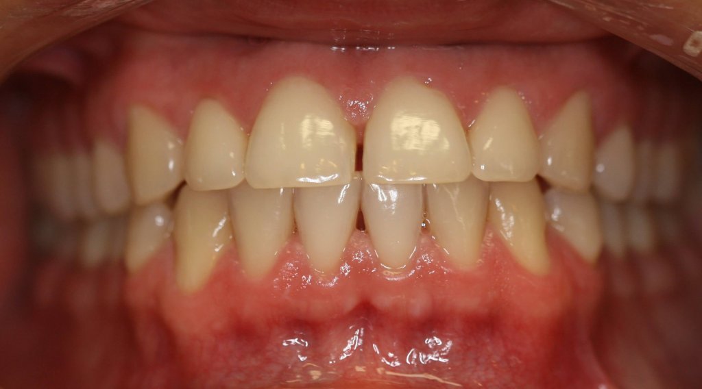Invisalign — Straightened Smile — before treatment