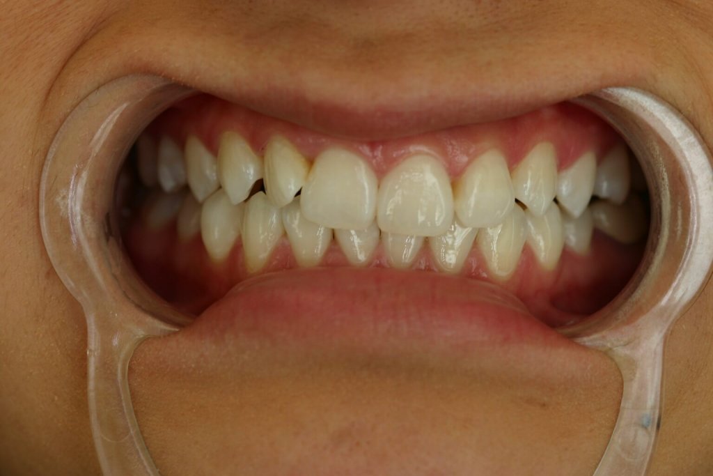 Zoom Whitening — Brighter Smile — after treatment