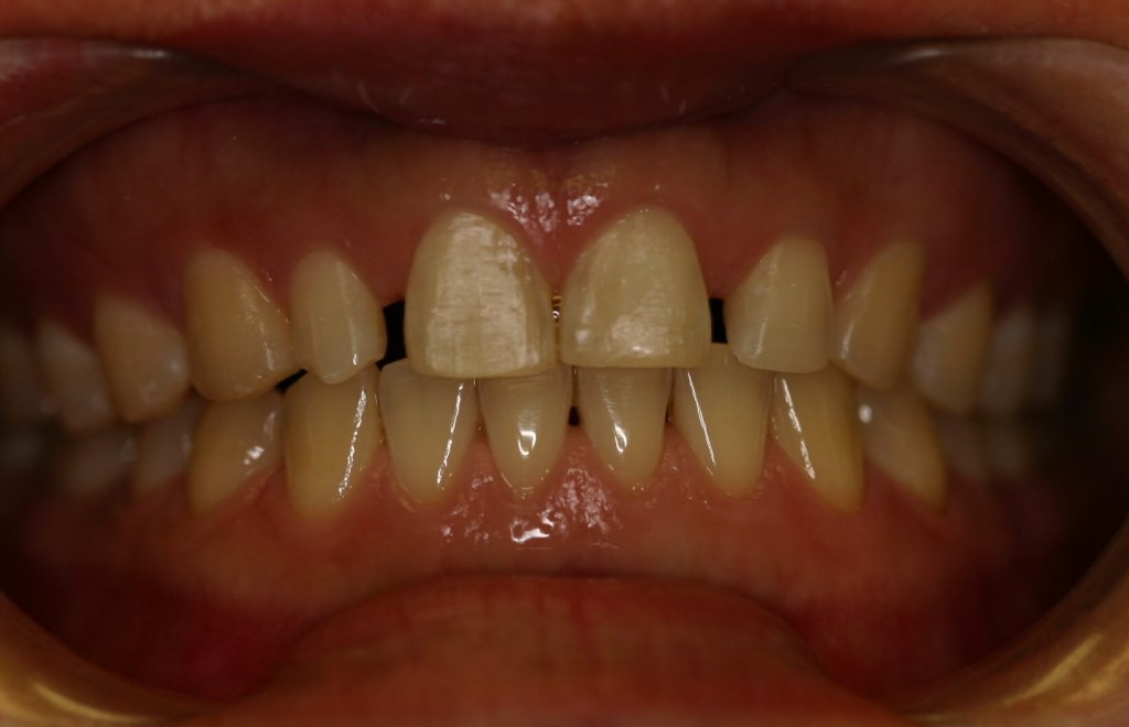 Zoom Whitening — Stain Removal — before treatment