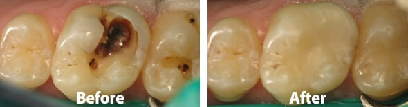 Composite Fillings Before and After