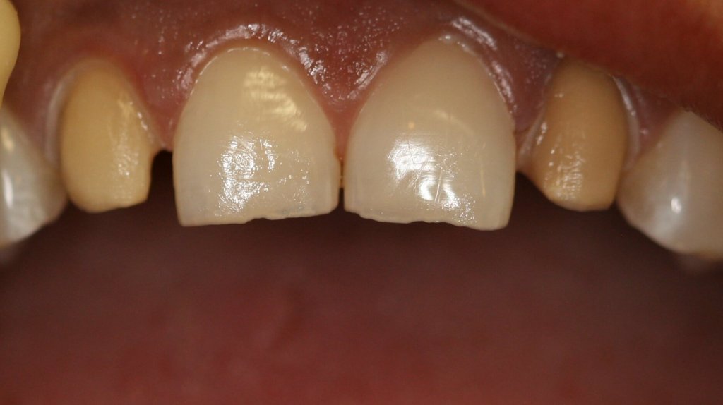 Dental Veneer - Case 1 - Before Picture