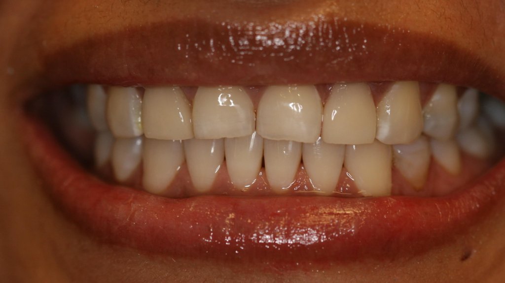 Dental Veneer - Case 1 - After Picture