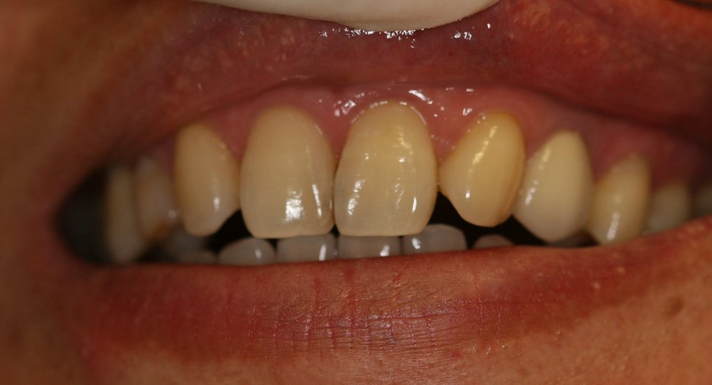 Dental Implant - Case 5 - After Picture