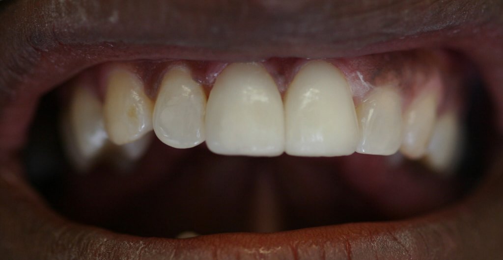 Dental Veneer - Case 3 - After Picture