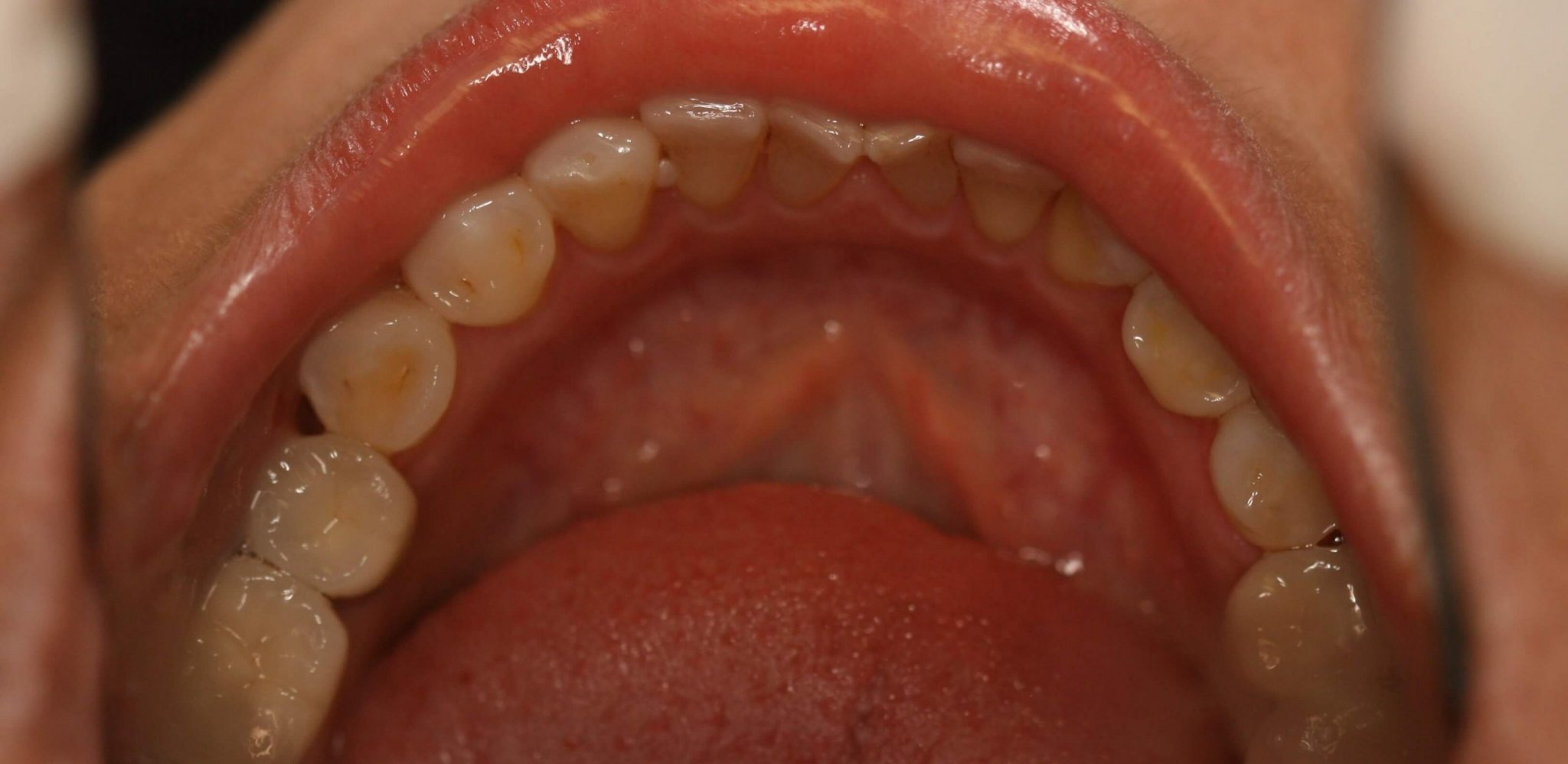 Dental Implant - Case 3 - After Picture