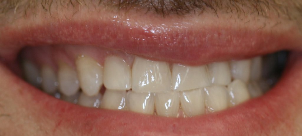 Dental Fillings - Case 1 - After Picture