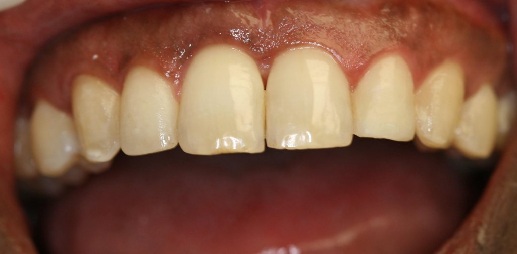 Dental Fillings - Case 3 - After Picture