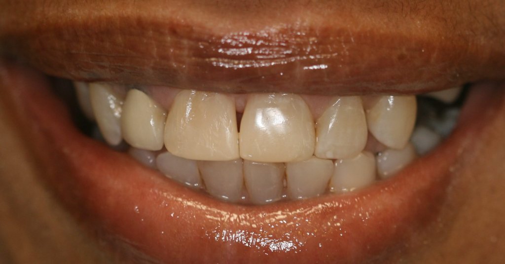 Dental Fillings - Case 4 - After Picture