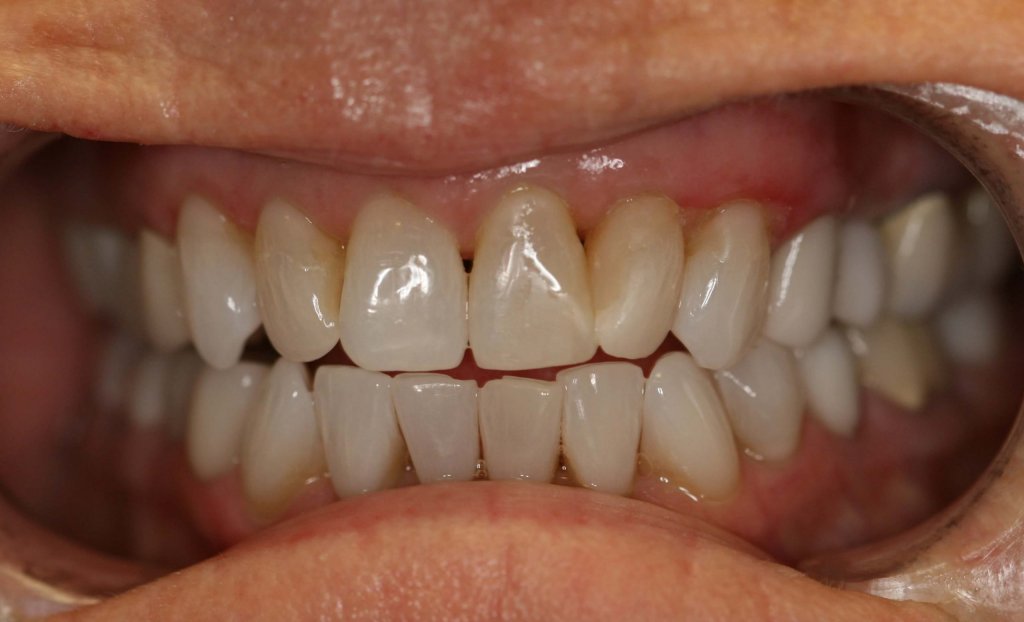 Dental Fillings - Case 5 - After Picture