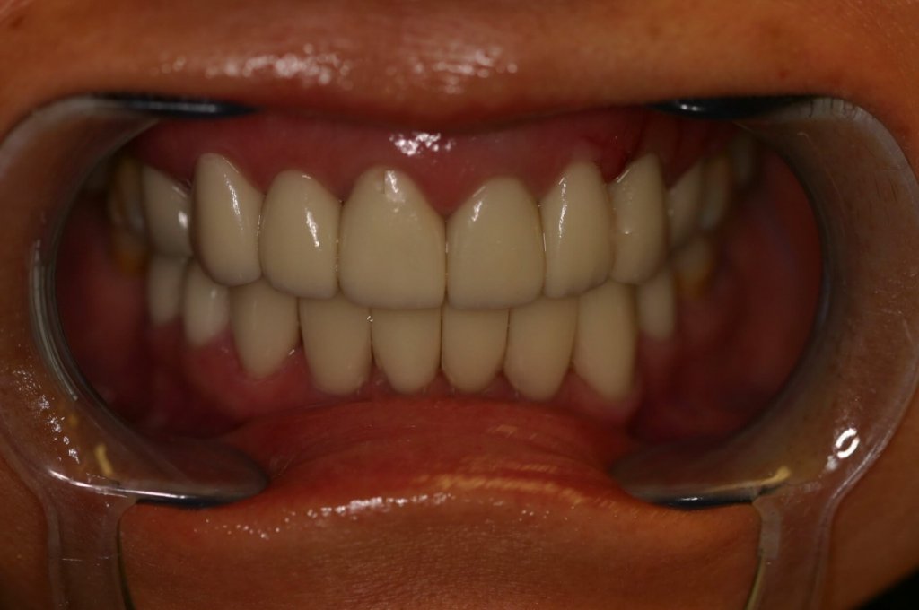 Dental Veneer - Case 2 - After Picture