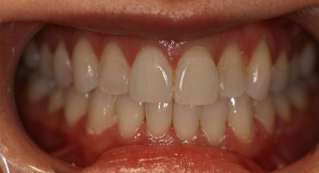 Invisalign - Case 1 - After Picture