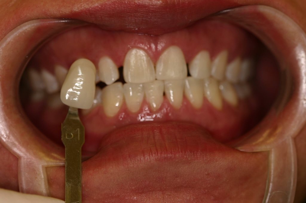 Zoom Whitening - Case 1 - After Picture