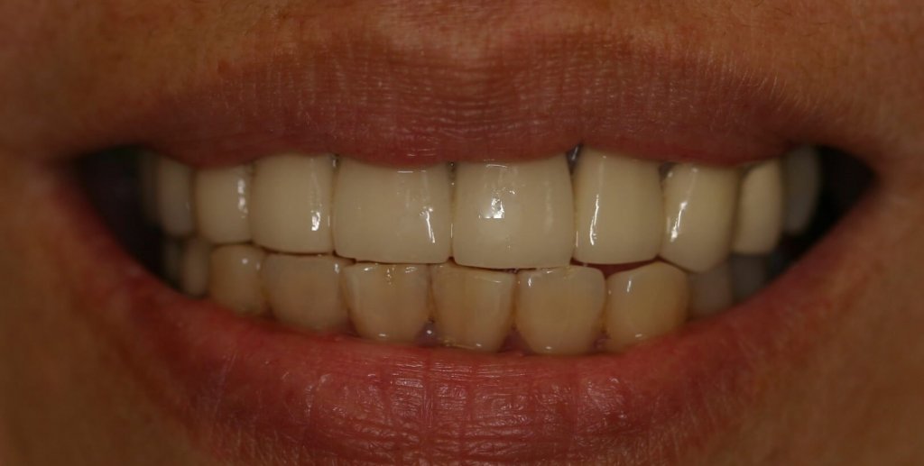 Dental Bridge - Case 1 - After Picture