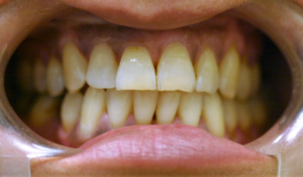 Dental Fillings - Case 2 - After Picture