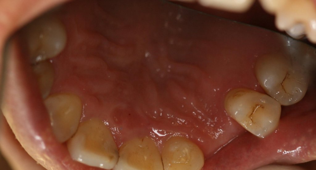 Dental Implant - Case 5 - Before Picture