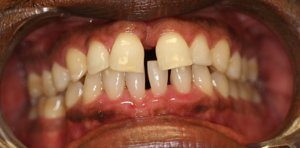 Dental Fillings - Case 3 - Before Picture