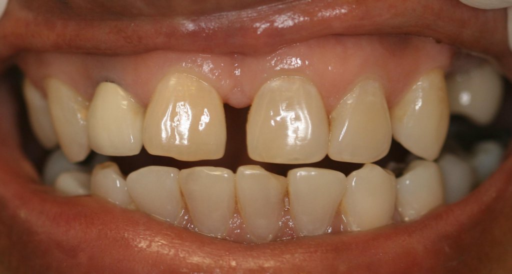 Dental Fillings - Case 4 - Before Picture