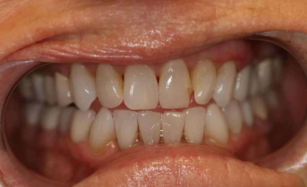 Dental Fillings - Case 5 - Before Picture