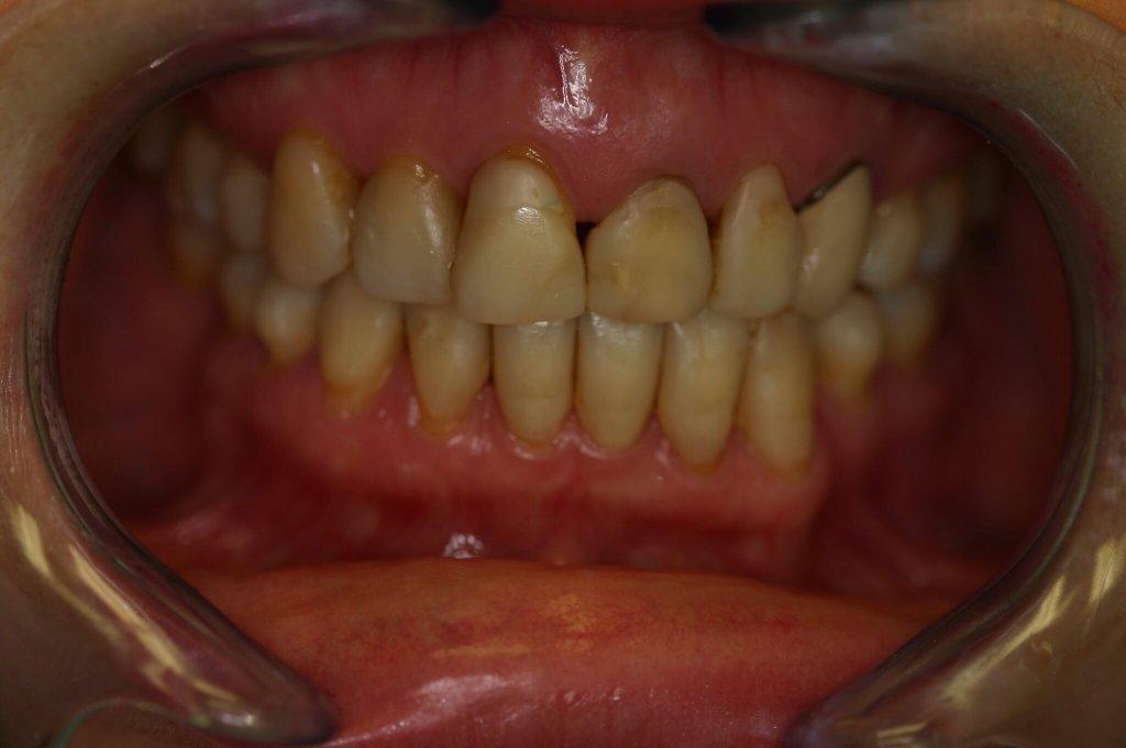 Dental Veneer - Case 2 - Before Picture