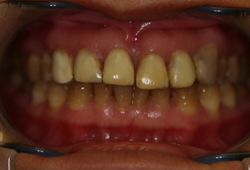 Dental Veneer - Case 4 - Before Picture