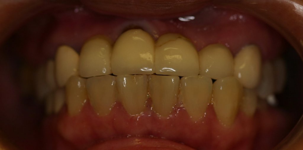 Dental Bridge - Case 1 - Before Picture