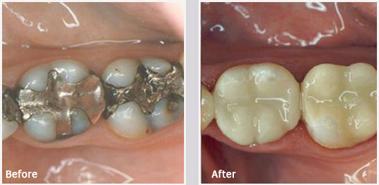 Before and After Amalgam