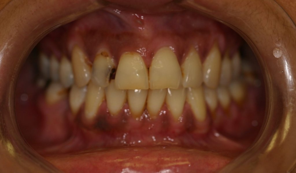 Dental Fillings - Case 2 - Before Picture