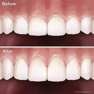 Gum Surgery Crown Lengthening