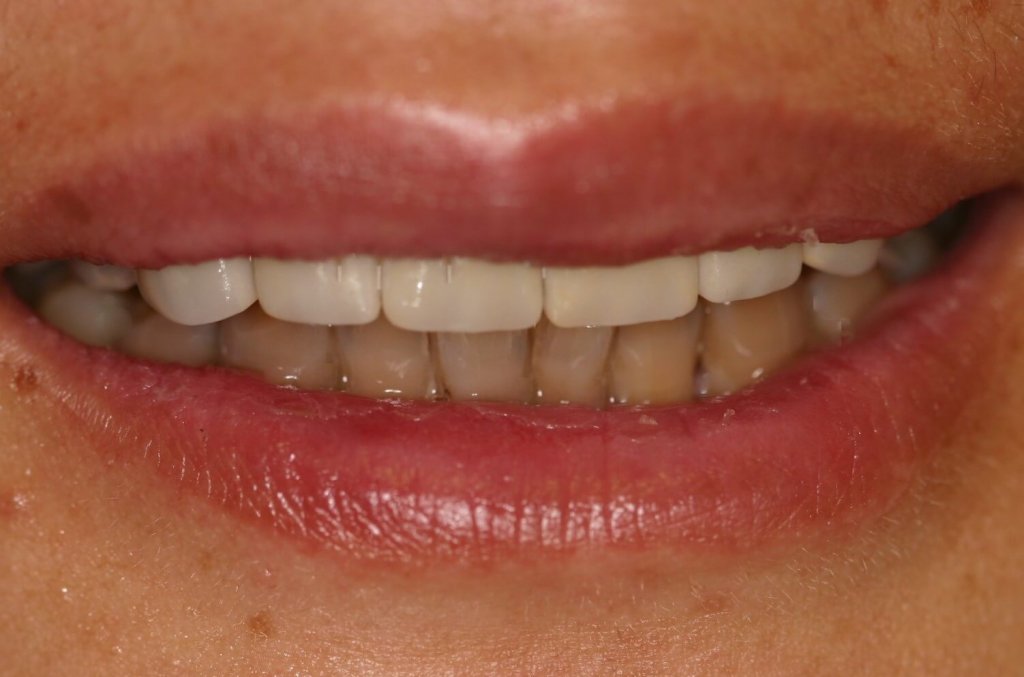 Dental Veneer - Case 4 - After Picture
