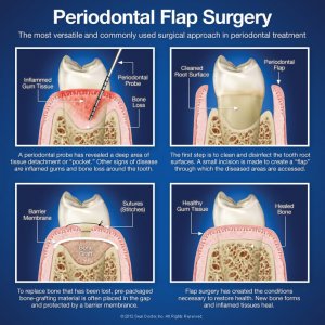 Periodontal Flap Surgery Before and After