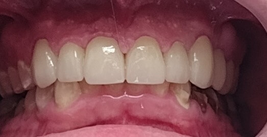 Crown – Case 10 – After Picture
