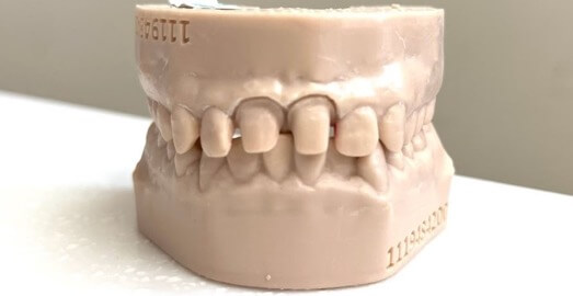 Crown – Case 8 – After Picture