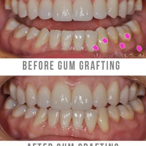Gum Grafting Surgery Before and After